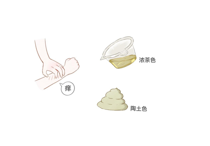 通常伴有皮肤瘙痒, 尿色如浓茶, 粪便成陶土色.