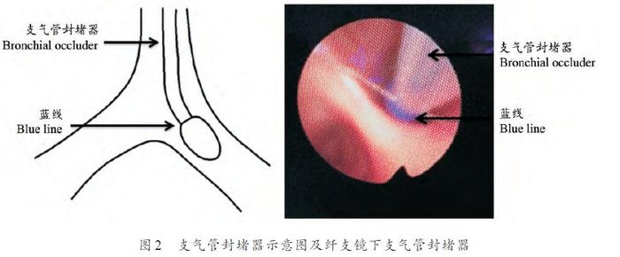 放置双腔气管插管的禁忌症包括气道困难,气管狭窄和气道解剖结构扭曲