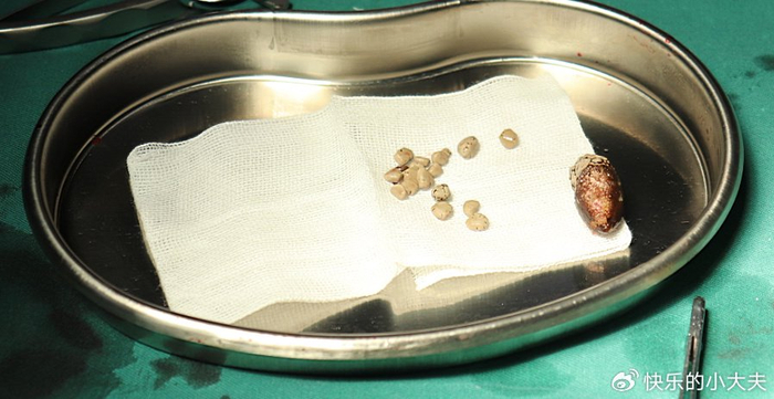 输尿管结石的成因