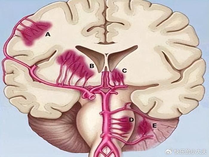 脑卒中里病死率最高