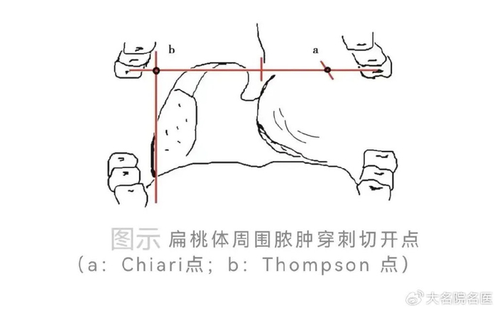 扁桃体|脓肿|腭舌弓_新浪新闻