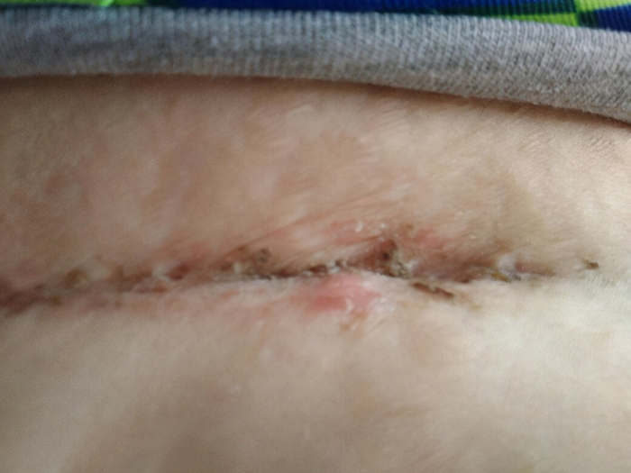 剖腹产太遭罪?医生有妙招:记住"五早三晚",身体恢复又快又好