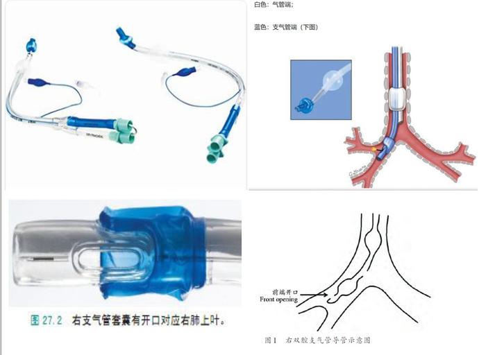 双腔气管导管插管技巧图片