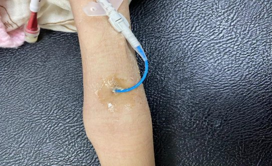 4岁患儿picc置管后淋巴液渗漏,这样处理1周恢复!你值得拥有!