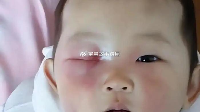 50天婴儿初次户外，只因妈妈一个错误，右眼被灼伤