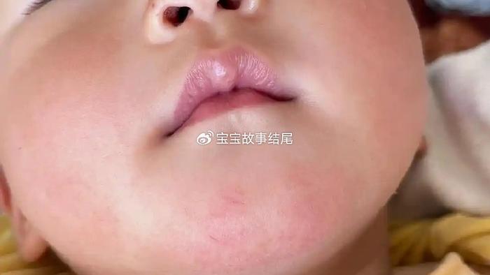 宝宝“口水疹”和“过敏”区别很大，很多妈妈都弄错
