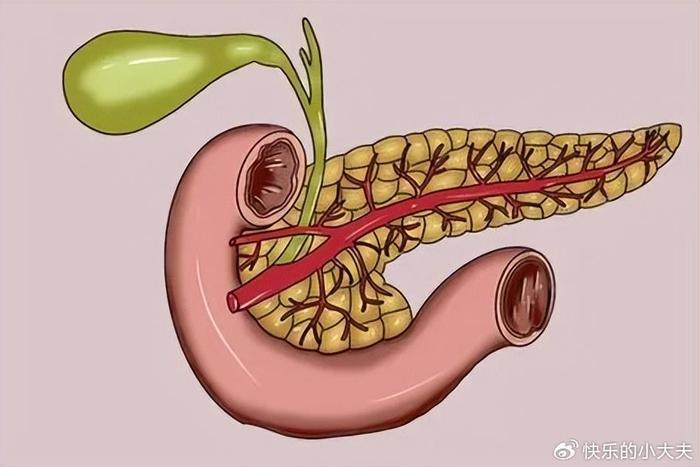 胰腺癌早期图片