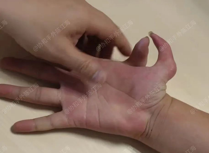 通过手术我们可以改变一部分的畸形外观和功能,但是可以调整的空间