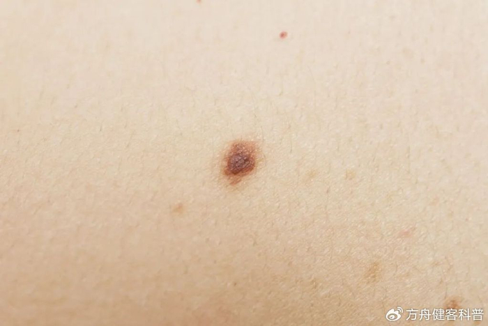 皮肤上的痣有这5个变化,小心癌症盯上你|癌症|黑色素瘤|部位_新浪新闻