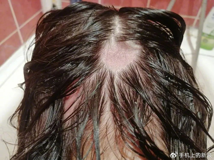 头皮摸到这种小凸起,千万不要抠啊啊啊!|毛囊炎_新浪新闻