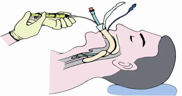 气管插管图片漫画图片