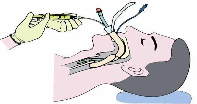 icu气管插管患者拔管指南的质量评价