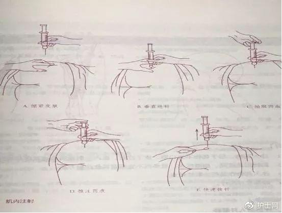 c,對需長期注射者,應交替更換注射部位,並選用細長針頭,以避免或減少