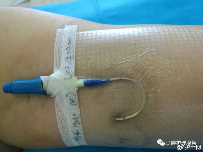 picc:0°揭敷料,Ω固定法,好经验快收藏!|贴膜|护士|敷贴_新浪新闻