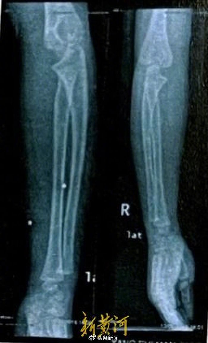 云南3岁女童被枪打伤后与23颗弹片"共生"8年,伤人者被立案后又撤销