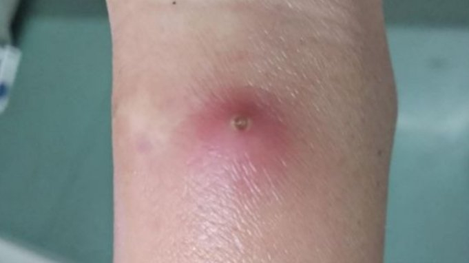 留置针拔除后针眼感染化脓,罪魁祸首竟然是这个!