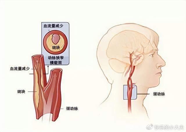 不可忽视的颈部隐患 颈动脉斑块 斑块如何形成?如何检测?