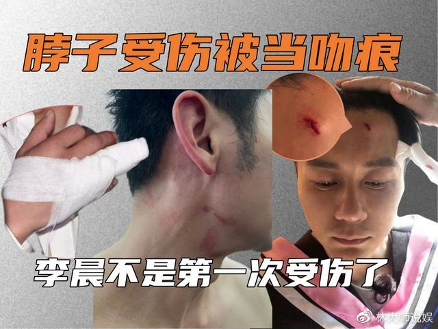 李晨奔跑吧脖子红印记否认新恋情_李晨综艺受伤敬业历史回顾_容易受伤的男人李晨