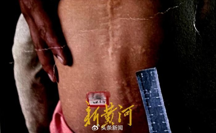 事情虽然已经过去了8年,但身体的不适应和中枪后处处留下的疤痕,仍在