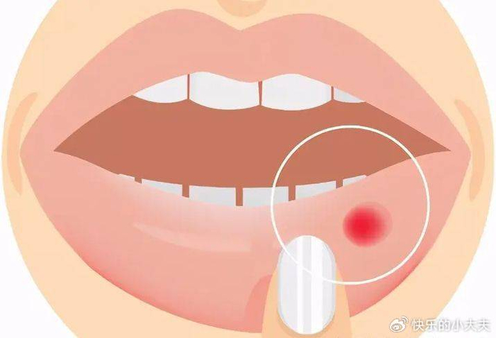 为什么春天会容易口腔溃疡?