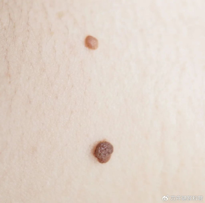 皮肤上的痣有这5个变化,小心癌症盯上