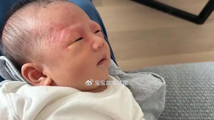 为何宝宝爱出现湿疹？除了衣服，这2个因素也很要注意