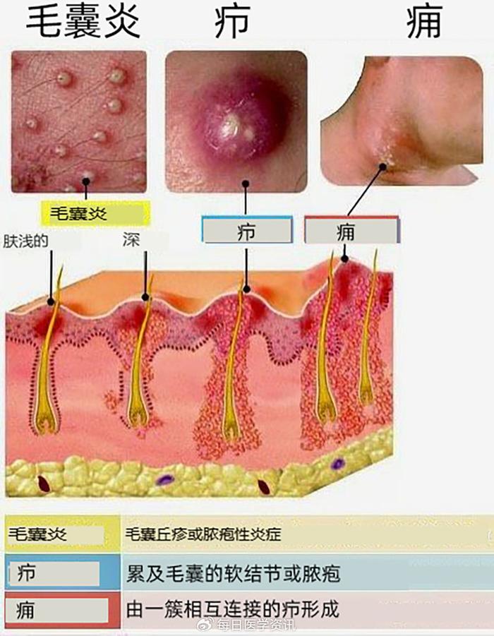 疖的图片大全图片