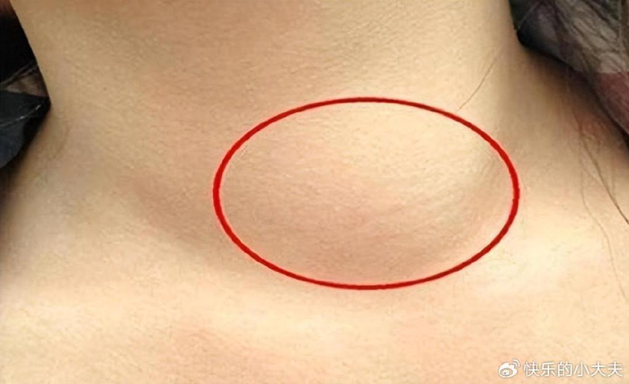 淋巴癌是源自淋巴系统的恶性肿瘤,包括淋巴结,脾脏,胸腺和骨髓等部位.