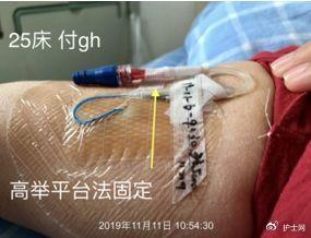 picc0揭敷料Ω固定法好經驗快收藏