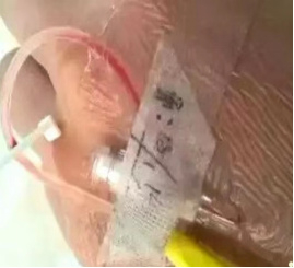 为什么叫正压留置针的解答「冲封管操作」 5 个问题,看完不纠结了_新闻资讯_第3张_活检穿刺产品网 为什么叫正压留置针的解答「冲封管操作」 5 个问题,看完不纠结了_https://www.jmylbn.com_新闻资讯_第3张