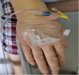 为什么叫正压留置针的解答「冲封管操作」 5 个问题,看完不纠结了_新闻资讯_第2张_活检穿刺产品网 为什么叫正压留置针的解答「冲封管操作」 5 个问题,看完不纠结了_https://www.jmylbn.com_新闻资讯_第2张