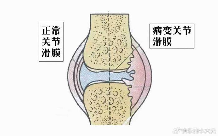 膝盖滑膜炎位置图图片