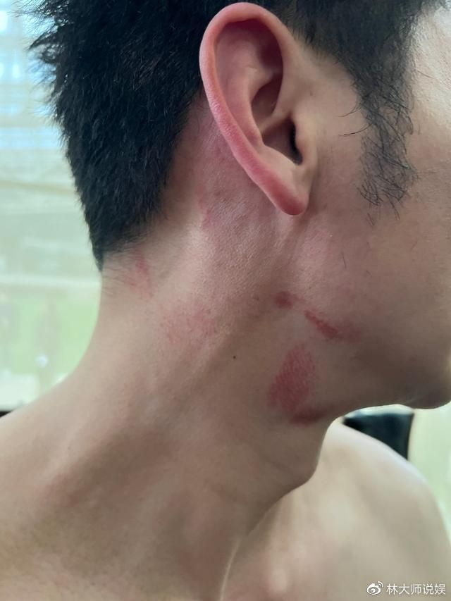李晨综艺受伤敬业历史回顾_容易受伤的男人李晨_李晨奔跑吧脖子红印记否认新恋情