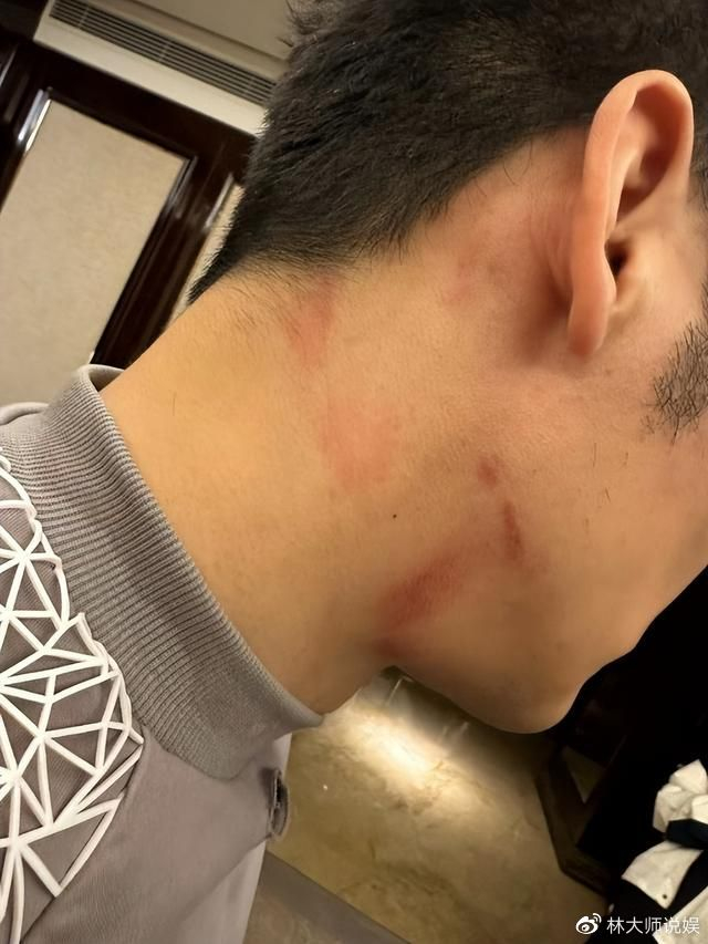 容易受伤的男人李晨_李晨奔跑吧脖子红印记否认新恋情_李晨综艺受伤敬业历史回顾