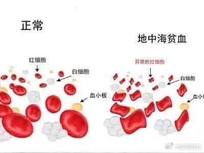 治療地中海型貧血不僅僅是補鐵揭秘3穴位調理助於養血活血