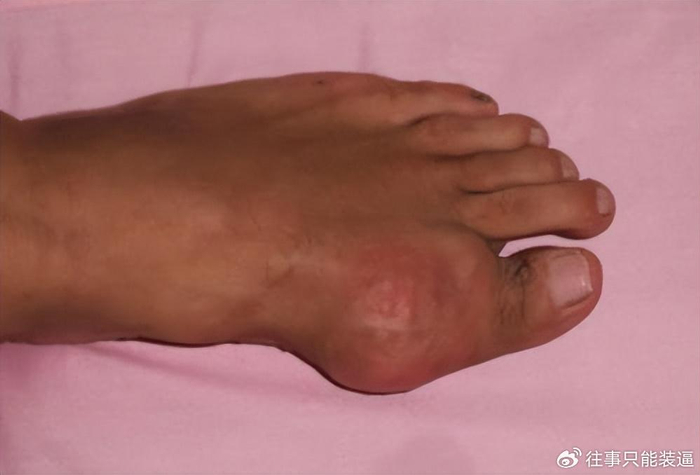 尿酸越高,痛风来的越快!经常尿酸偏高这地方疼,预示痛风已上身