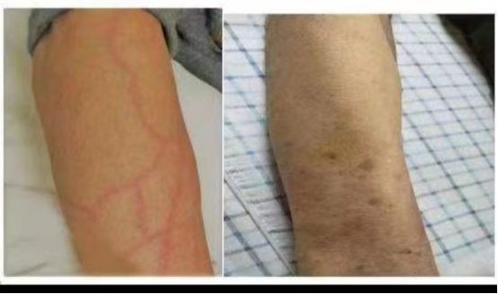 案例静脉炎次日就消退不见多亏了这样处理附整改措施