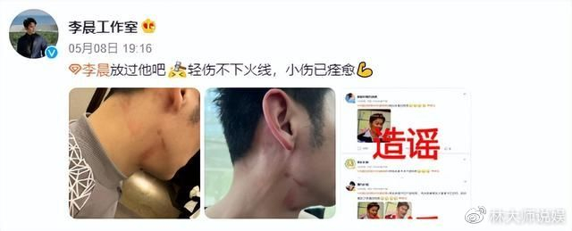 李晨综艺受伤敬业历史回顾_李晨奔跑吧脖子红印记否认新恋情_容易受伤的男人李晨
