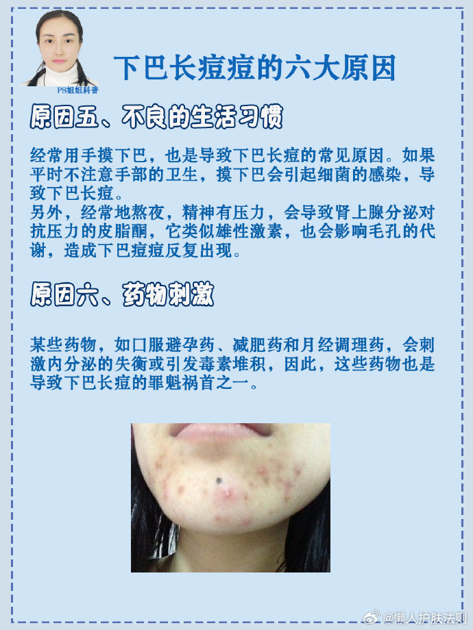 亲爱的姐妹们你们有没有发现下巴上长痘痘呢你知道是什么原因引起的吗