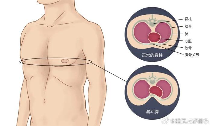 人的心口窝的位置图片图片