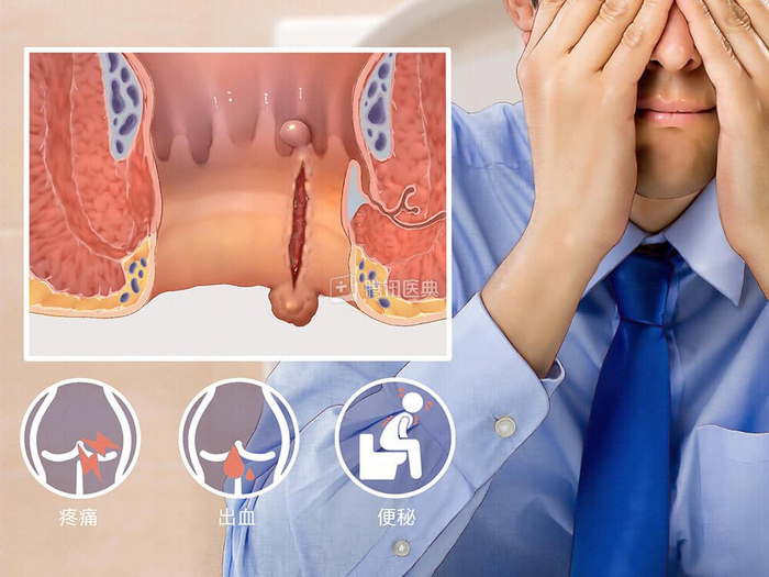 郑州丰益肛肠医院为你解答!|肛裂|愈合|肛门_新浪新闻