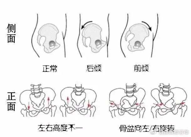 骨盆前倾:同产后腰痛相同,骨盆前倾还可能影响腰部肌肉的平衡,导致