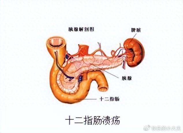 十二指肠溃疡解剖图图片