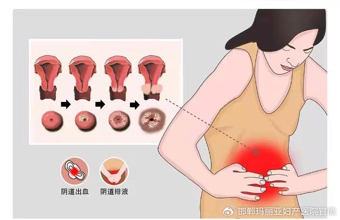 女人宫颈癌的前兆初期图片