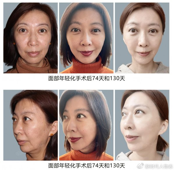 杜太超医生拉皮手术案例众多,并且每一个求美者都是私人定制手术方案