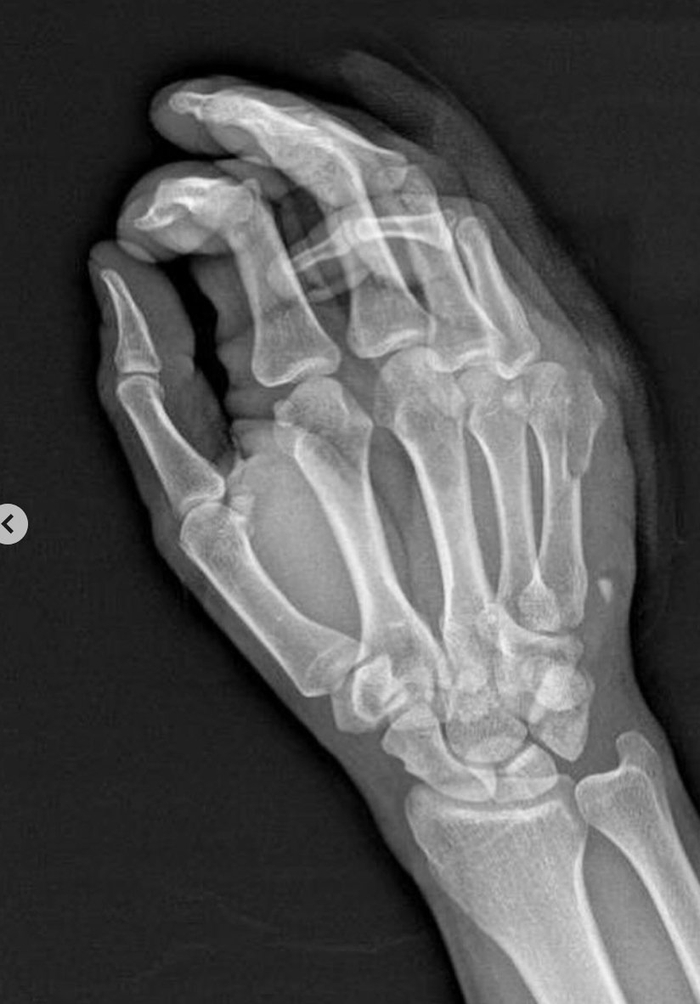 右第五掌骨骨折术后x光片曝光,钢板螺钉固定治疗