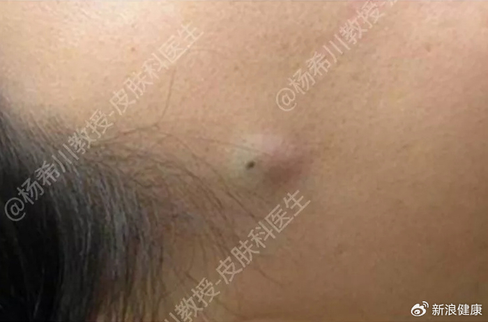 (图源文献2)疖肿早期常表现为局部红肿热痛的小硬结,后逐渐肿大,疼痛