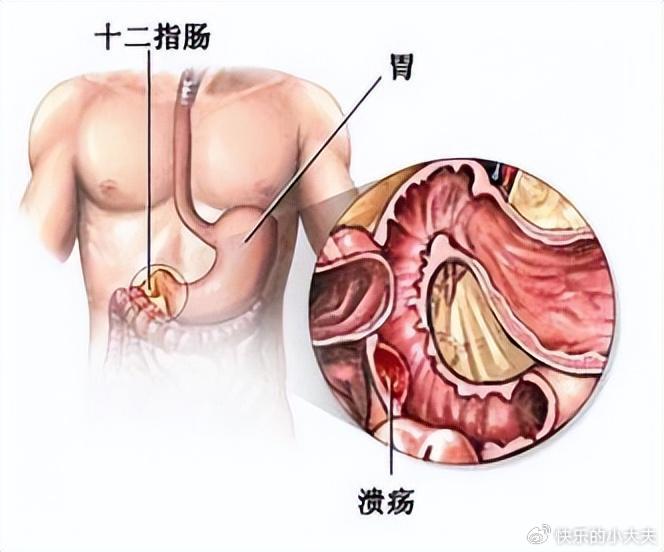 十二指肠炎疼痛位置图图片