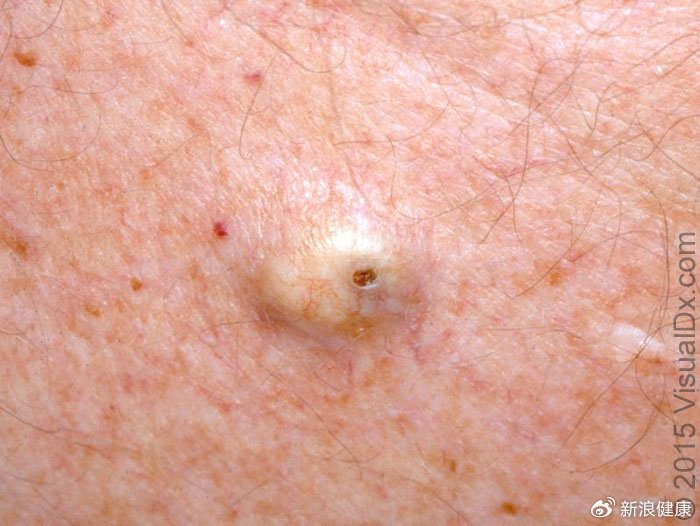 (图源文献2)疖肿早期常表现为局部红肿热痛的小硬结,后逐渐肿大,疼痛