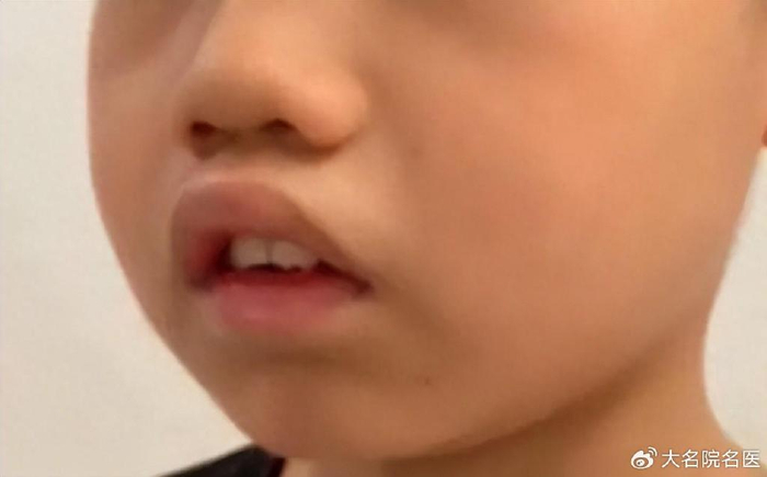 孩子腺样体肥大该怎么办?快来试试中医治疗吧!